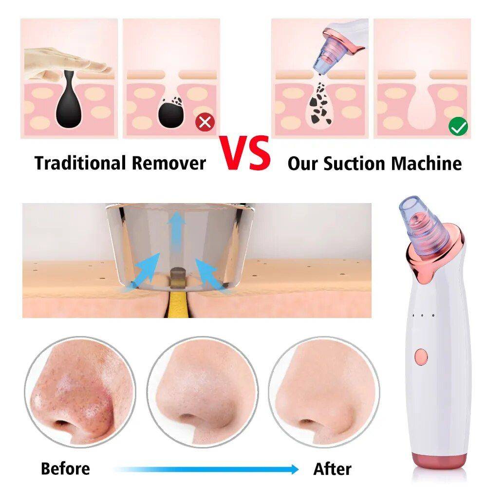 Electric Facial Vacuum Blackhead & Acne Remover with Deep Pore Cleaning Tools Health & Beauty Skin Care  